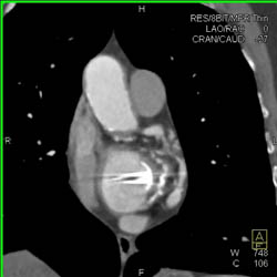 Aortic Valve Replacement (AVR) and Mitral Valve Replacement - CTisus CT Scan