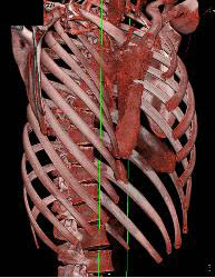 Pectus Deformity - CTisus CT Scan
