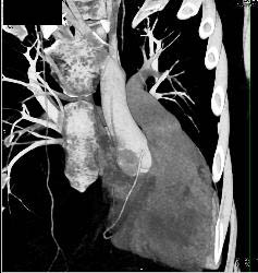 Pectus Deformity - CTisus CT Scan