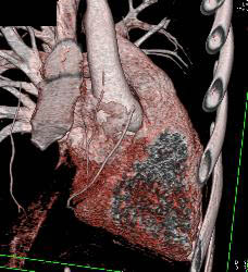 Pectus Deformity - CTisus CT Scan