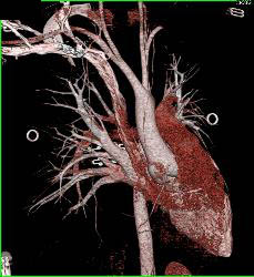 Gated Normal Ascending Aorta - CTisus CT Scan