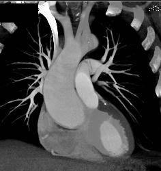 Dilated Aortic Root - CTisus CT Scan