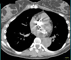 Evaluation of Endovascular Stent With Multiple Images - CTisus CT Scan