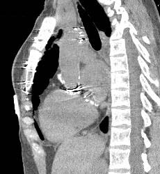 Evaluation of Endovascular Stent With Multiple Images - CTisus CT Scan