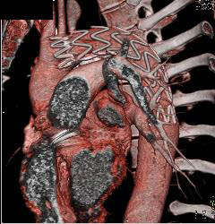 Evaluation of Endovascular Stent With Multiple Images - CTisus CT Scan