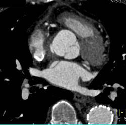 Endovascular Stent in Descending Aorta - CTisus CT Scan