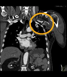 Stab Wound With Broken Blade in Chest Causing Artifact - CTisus CT Scan