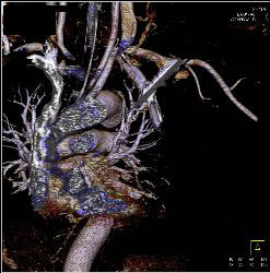 Stab Wound With Broken Blade in Chest Causing Artifact - CTisus CT Scan