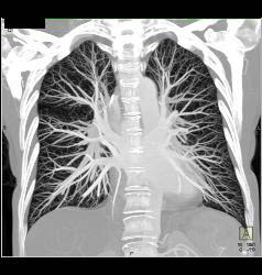 Normal Pulmonary Vascularity - CTisus CT Scan