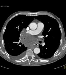 Lung Cancer Invades and Encases the Esophagus- Stent Placed in Esophagus - CTisus CT Scan