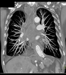 Lung Cancer Invades and Encases the Esophagus- Stent Placed in Esophagus - CTisus CT Scan