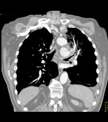 Small Cell Lung Cancer Encases the Left Mainstem Bronchus - CTisus CT Scan