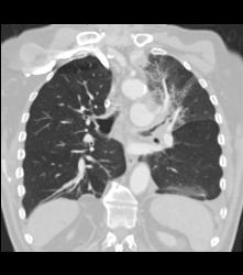Small Cell Lung Cancer Encases the Left Mainstem Bronchus - CTisus CT Scan