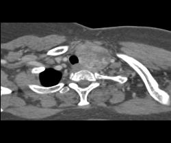 Goiter - CTisus CT Scan