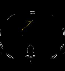 Dilated Aortic Root With Differing Measurements Based on How They Are Made - CTisus CT Scan