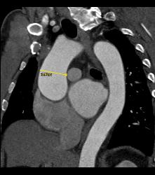 Dilated Aortic Root With Differing Measurements Based on How They Are Made - CTisus CT Scan