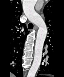 Dilated Aortic Root With Differing Measurements Based on How They Are Made - CTisus CT Scan