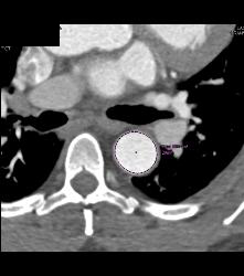 Dilated Aortic Root With Differing Measurements Based on How They Are Made - CTisus CT Scan