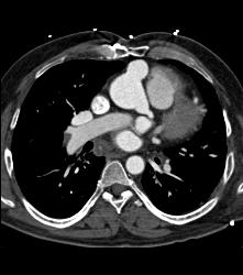 Pseudoaneurysm Off Aorta - CTisus CT Scan