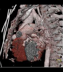 Pseudoaneurysm Off Aorta - CTisus CT Scan