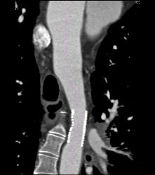 Pseudoaneurysm Off Aorta - CTisus CT Scan