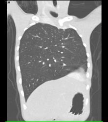 Pectus Deformity With Hypoplastic Left Lung - CTisus CT Scan