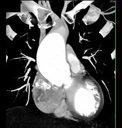 Dilated Ascending Aorta - CTisus CT Scan