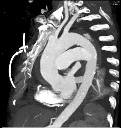 Leak From Descending Aorta - CTisus CT Scan