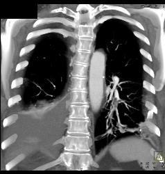 Pulmonary Embolism (PE) in Right Pulmonary Artery and Left as Well- See Full Sequence - CTisus CT Scan