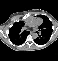 Root Repair With Reimplantation of Coronary Artery and Leak Presented as A Chest Wall Mass - CTisus CT Scan