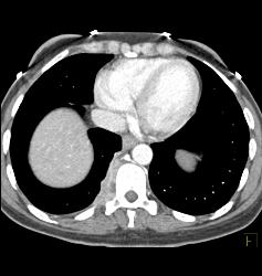 Pleural Implants - CTisus CT Scan