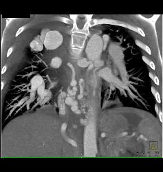 Incredible Pulmonary Vascular Malformation - CTisus CT Scan