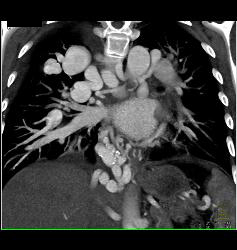 Incredible Pulmonary Vascular Malformation - CTisus CT Scan