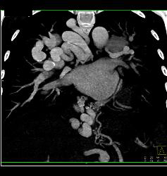 Incredible Pulmonary Vascular Malformation - CTisus CT Scan