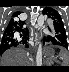 Incredible Pulmonary Vascular Malformation - CTisus CT Scan