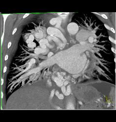 Incredible Pulmonary Vascular Malformation - CTisus CT Scan