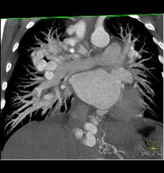 Incredible Pulmonary Vascular Malformation - CTisus CT Scan