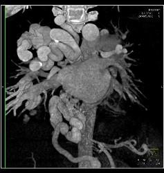 Incredible Pulmonary Vascular Malformation - CTisus CT Scan