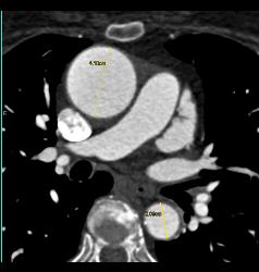 Dilated Aortic Root and Nice Left Atrial Appendage - CTisus CT Scan