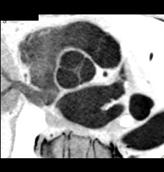 Normal Aortic Valve - CTisus CT Scan