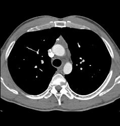 Thymoma - CTisus CT Scan