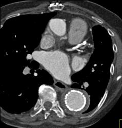 Endovascular Stent Repair With Endoleak- See Full Sequence - CTisus CT Scan