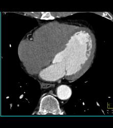 Left Anterior Descending Coronary Artery (LAD) and Right Coronary Artery (RCA) Disease - CTisus CT Scan
