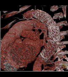 Endovascular Stent in Thoracic Aorta - CTisus CT Scan