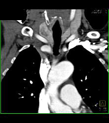 Thyroid Goiter - CTisus CT Scan