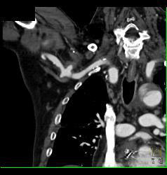 Ulceration in Axillary Artery S/p Trauma - CTisus CT Scan
