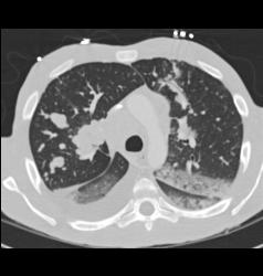 Lymphoma With Tumor in Airway and Lung Parenchyma in Addition to Adenopathy - CTisus CT Scan