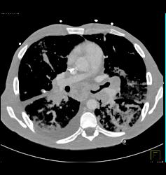 Lymphoma With Tumor in Airway and Lung Parenchyma in Addition to Adenopathy - CTisus CT Scan