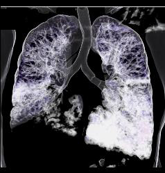 Lymphoma With Tumor in Airway and Lung Parenchyma in Addition to Adenopathy - CTisus CT Scan
