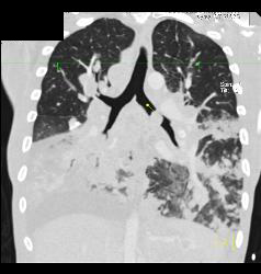 Lymphoma With Tumor in Airway and Lung Parenchyma in Addition to Adenopathy - CTisus CT Scan